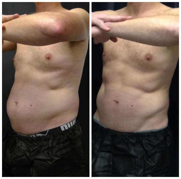 Body contouring before and after — CosMedic LaserMD