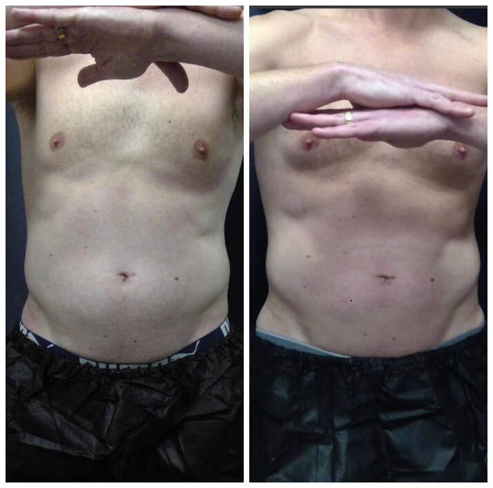 Body contouring before and after — CosMedic LaserMD