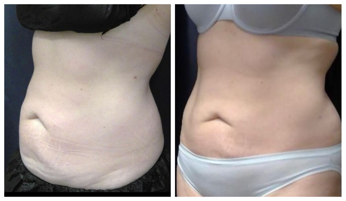 Body contouring before and after — CosMedic LaserMD