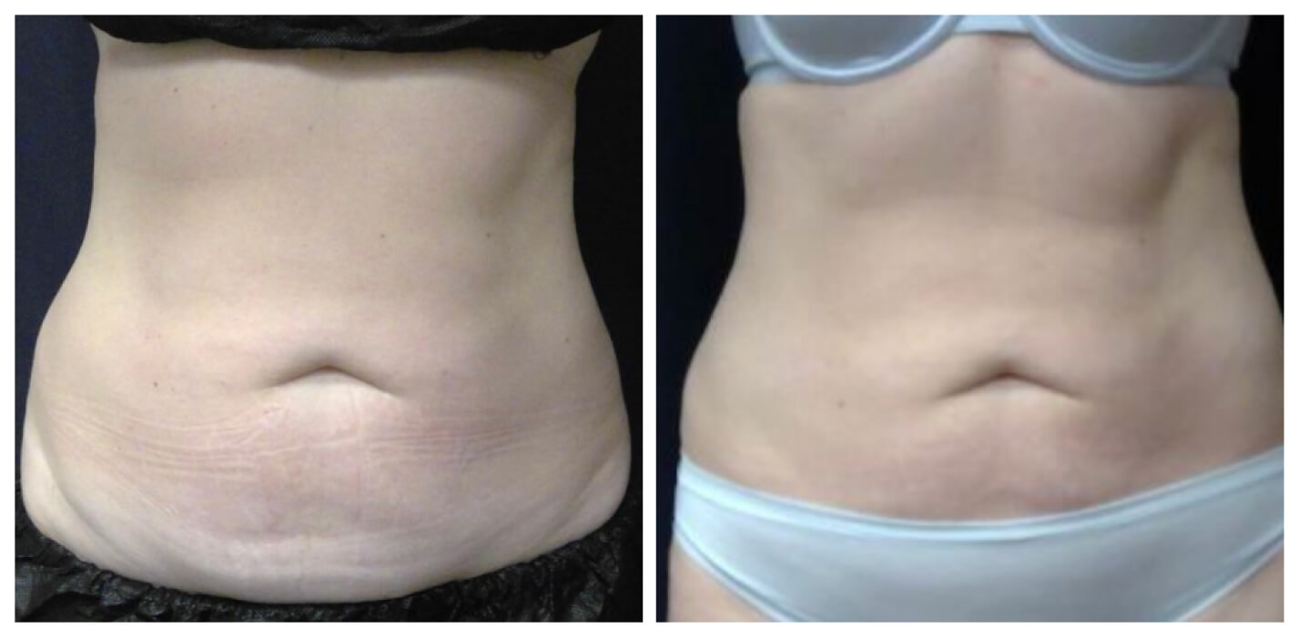 Body contouring before and after — CosMedic LaserMD