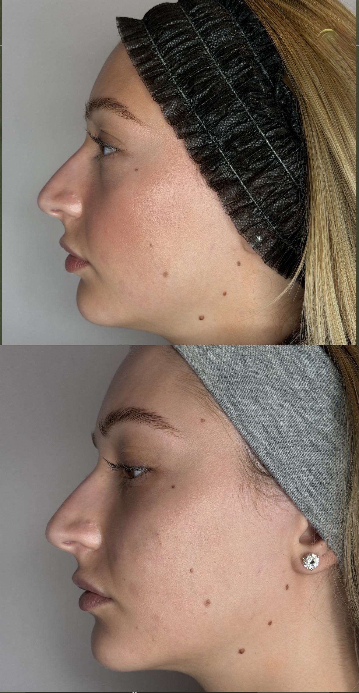 Jawline contouring before and after — CosMedic LaserMD