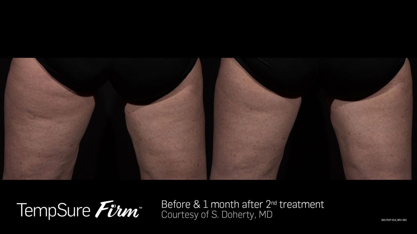 Cellulite treatment before and after — CosMedic LaserMD