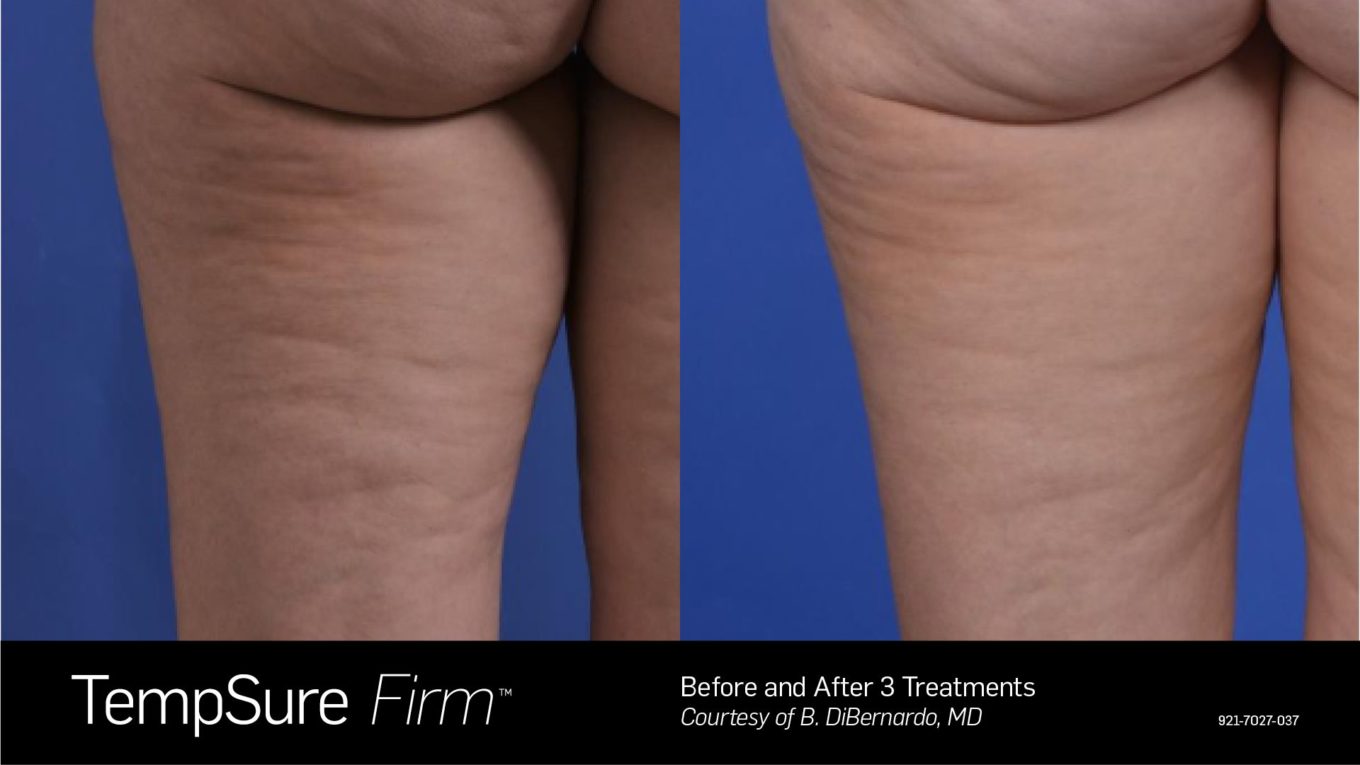 Cellulite treatment before and after — CosMedic LaserMD