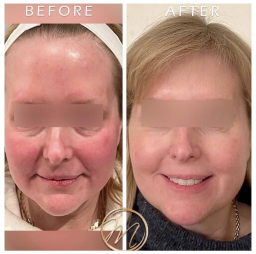Dermal fillers before and after — CosMedic LaserMD