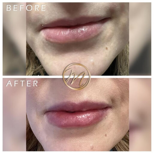 Dermal fillers before and after — CosMedic LaserMD