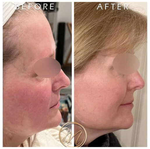 Dermal fillers before and after — CosMedic LaserMD