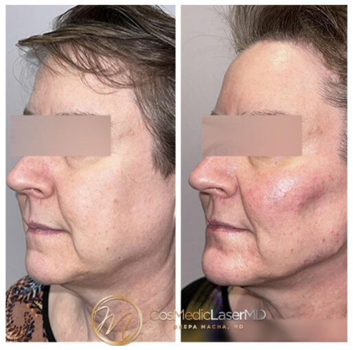 Dermal fillers before and after — CosMedic LaserMD