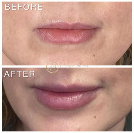 Dermal fillers before and after — CosMedic LaserMD