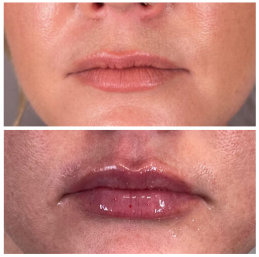 Dermal fillers before and after — CosMedic LaserMD