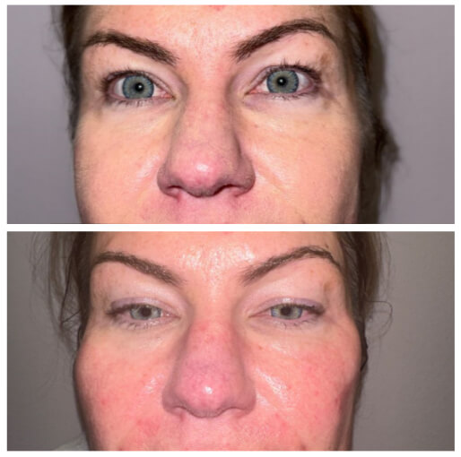 Dermal fillers before and after — CosMedic LaserMD