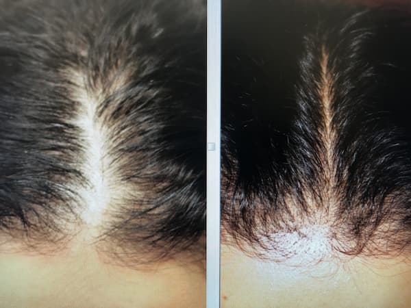 PepFactor before and after — CosMedic LaserMD