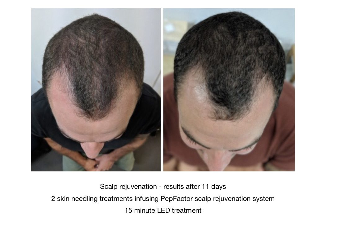 PepFactor before and after — CosMedic LaserMD
