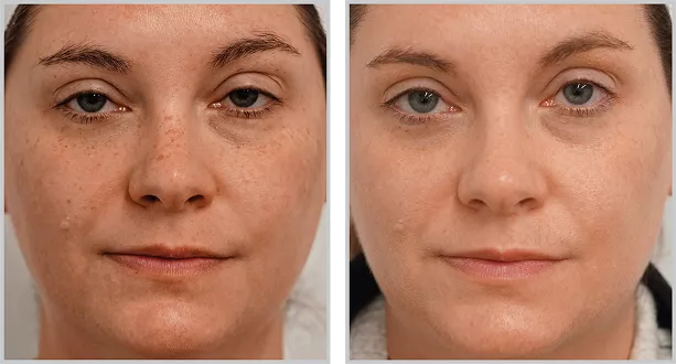 Sciton BBL HEROic before and after — CosMedic LaserMD