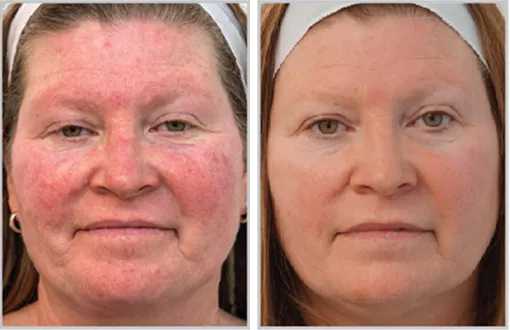 Sciton BBL HEROic before and after — CosMedic LaserMD
