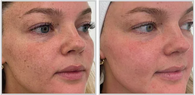 Sciton BBL HEROic before and after — CosMedic LaserMD