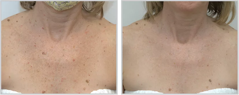Sciton BBL HEROic before and after — CosMedic LaserMD