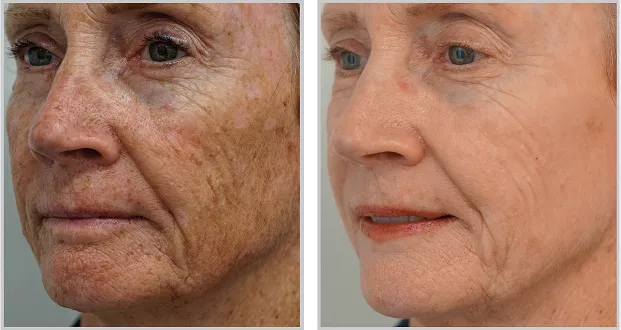 Sciton BBL HEROic before and after — CosMedic LaserMD