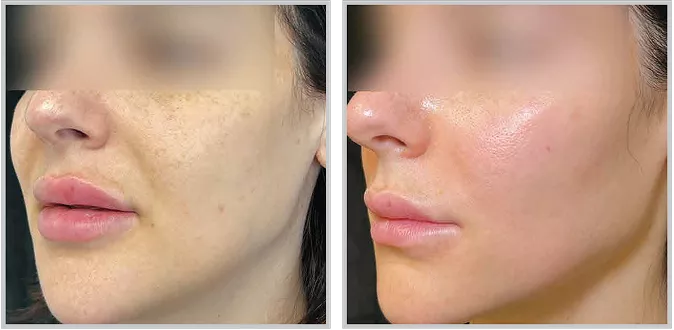 Sciton BBL HEROic before and after — CosMedic LaserMD