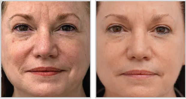 Sciton BBL HEROic before and after — CosMedic LaserMD