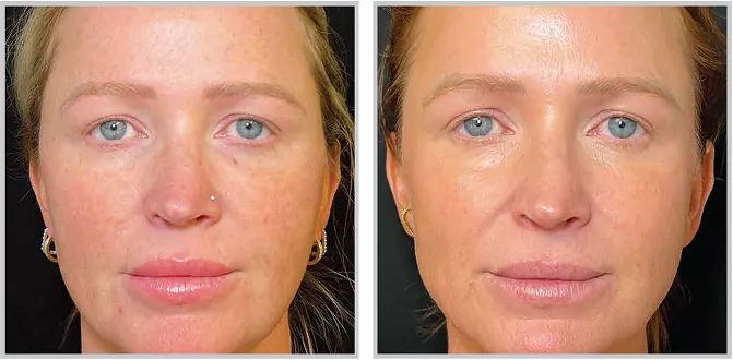 Sciton BBL HEROic before and after — CosMedic LaserMD