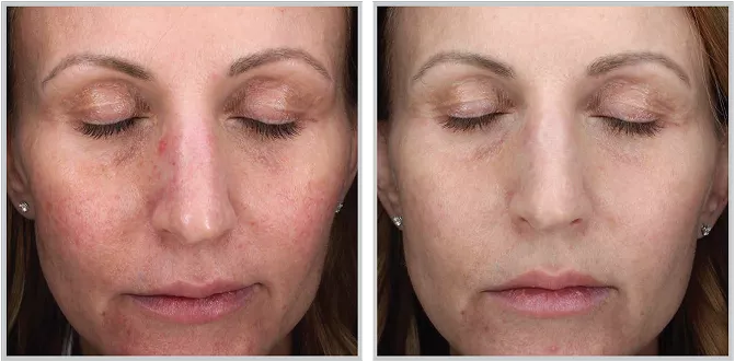 Sciton BBL HEROic before and after — CosMedic LaserMD