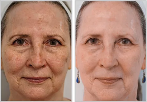 Sciton BBL HEROic before and after — CosMedic LaserMD