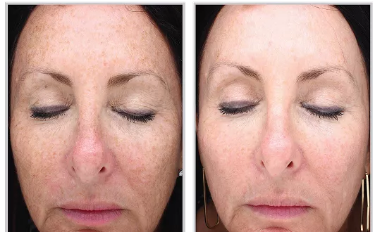 Sciton HALO before and after — CosMedic LaserMD