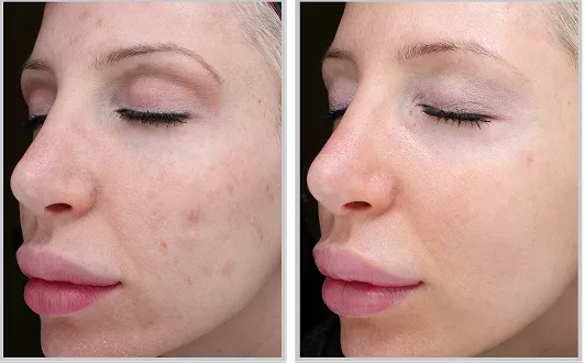Sciton HALO before and after — CosMedic LaserMD