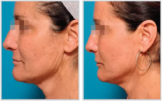 Sciton HALO before and after — CosMedic LaserMD