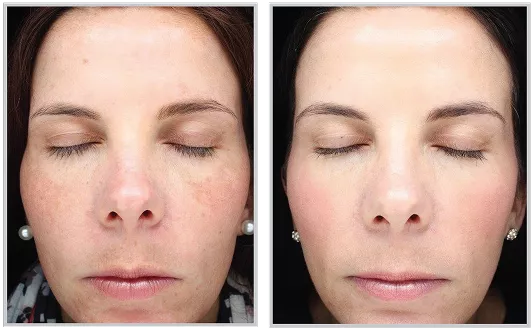 Sciton HALO before and after — CosMedic LaserMD