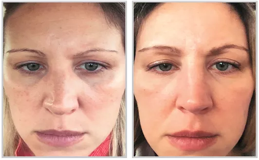 Sciton HALO before and after — CosMedic LaserMD
