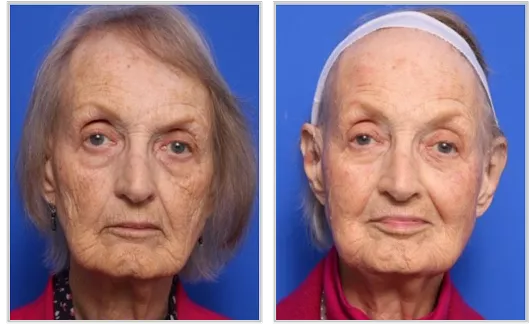 Sciton HALO before and after — CosMedic LaserMD