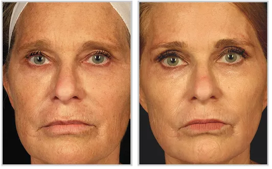 Sciton HALO before and after — CosMedic LaserMD