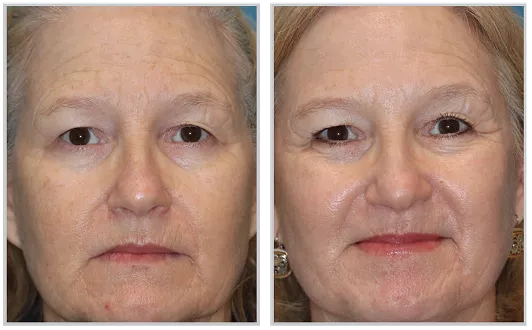 Sciton HALO before and after — CosMedic LaserMD