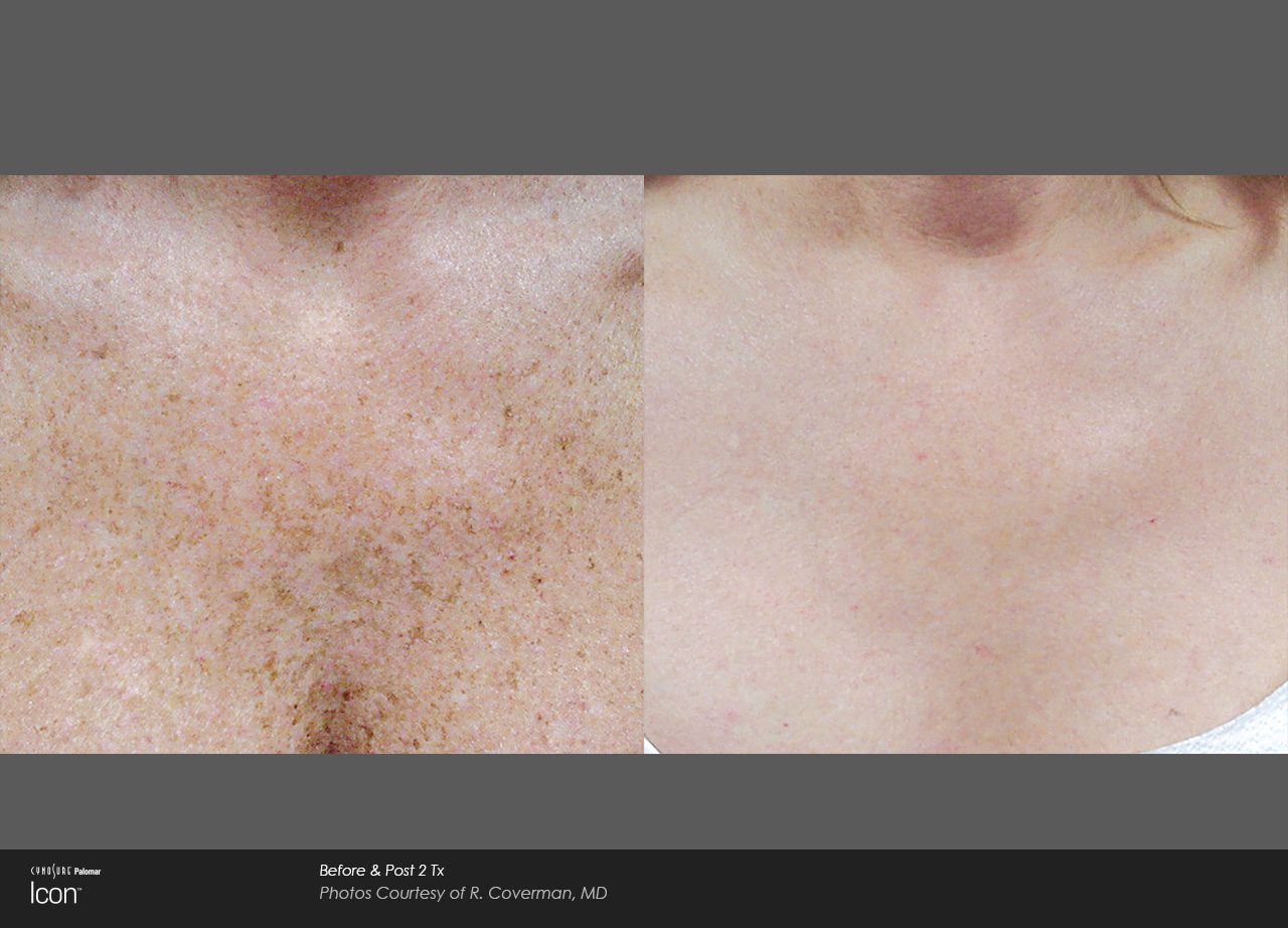 Sun spots and pigmentation before and after — CosMedic LaserMD