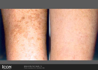 Sun spots and pigmentation before and after — CosMedic LaserMD