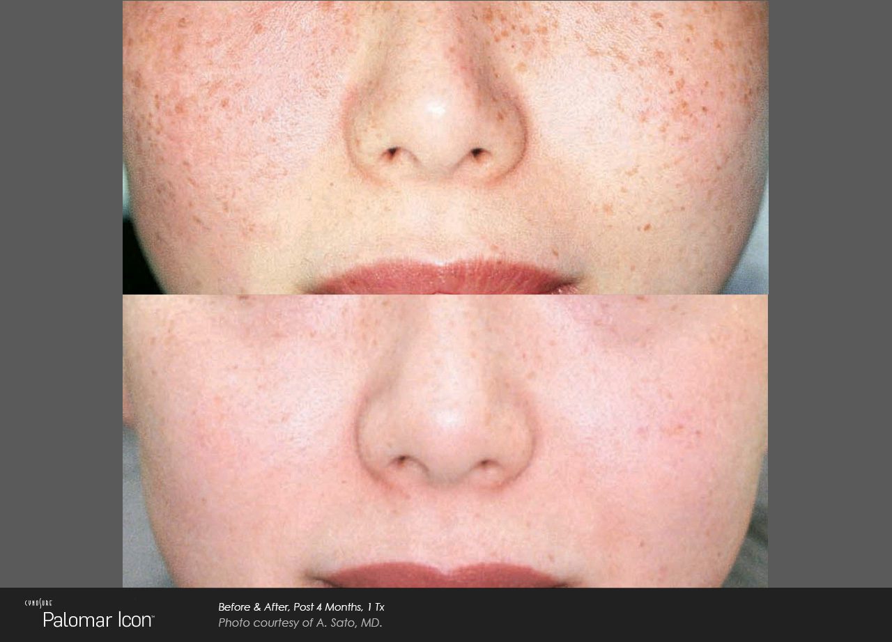 Sun spots and pigmentation before and after — CosMedic LaserMD