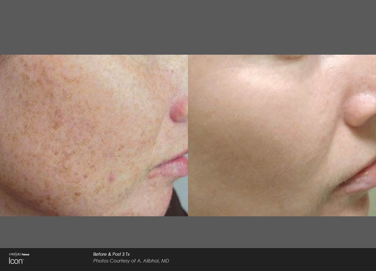 Sun spots and pigmentation before and after — CosMedic LaserMD