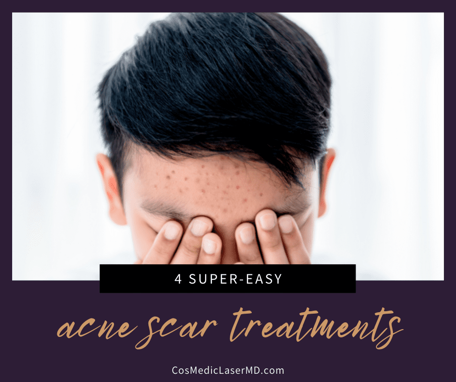4 Easy Acne Scar Treatments You Can Get in Ann Arbor