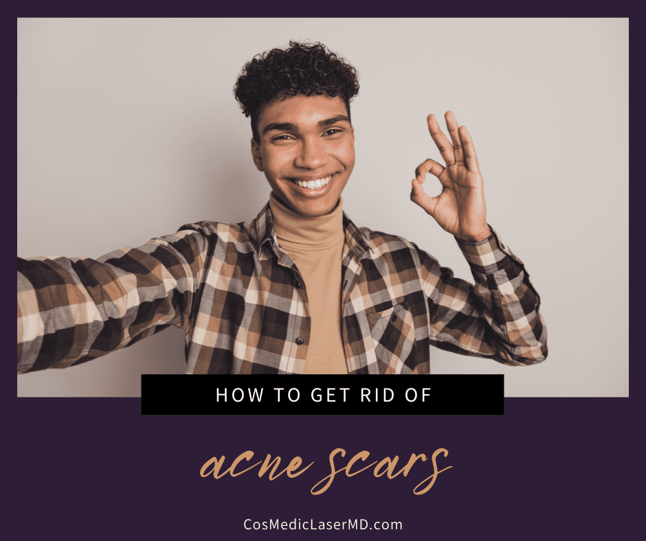 Acne Scarring Treatments in Ann Arbor
