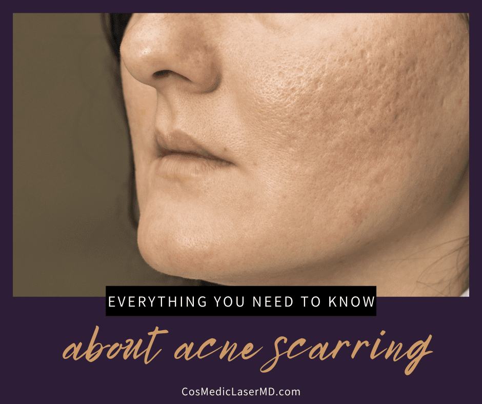 Everything You Need to Know About Acne Scars (and How to Treat Them)