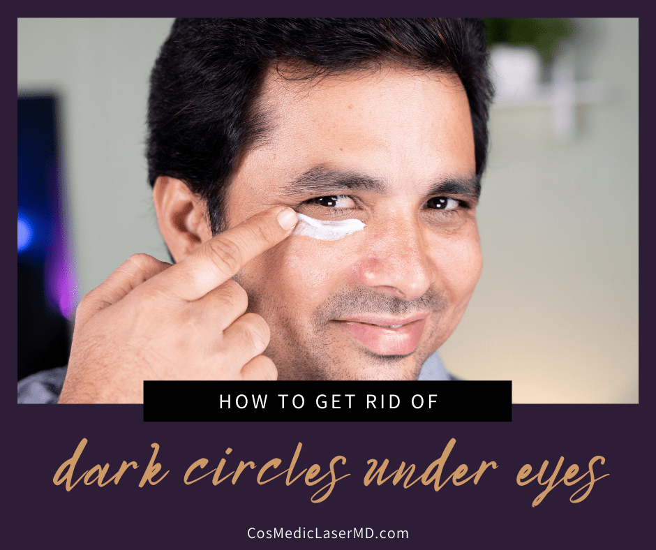 How to Treat Dark Circles Under Eyes