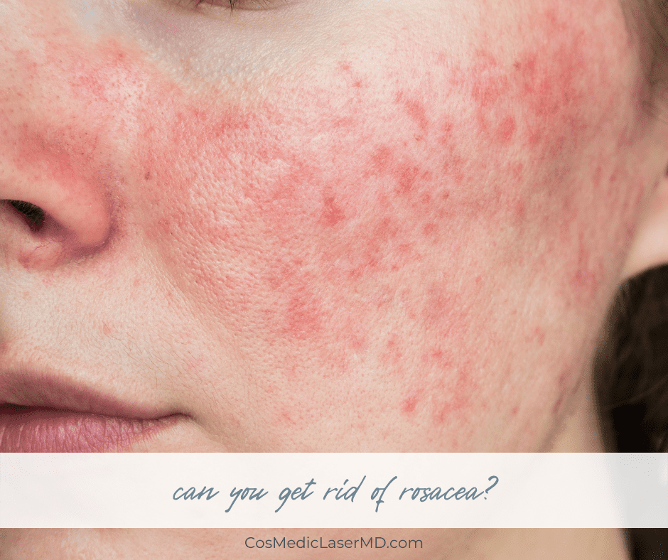 How to Get Rid of Rosacea