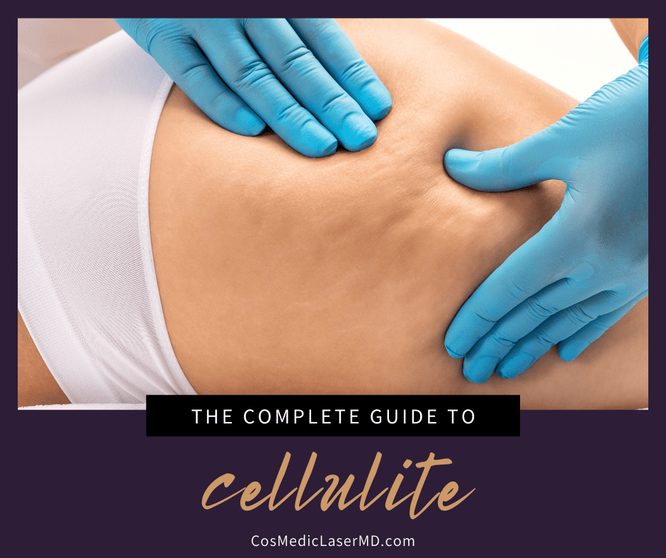Your Complete Guide to Cellulite (Including Treatments to Get Rid of It)