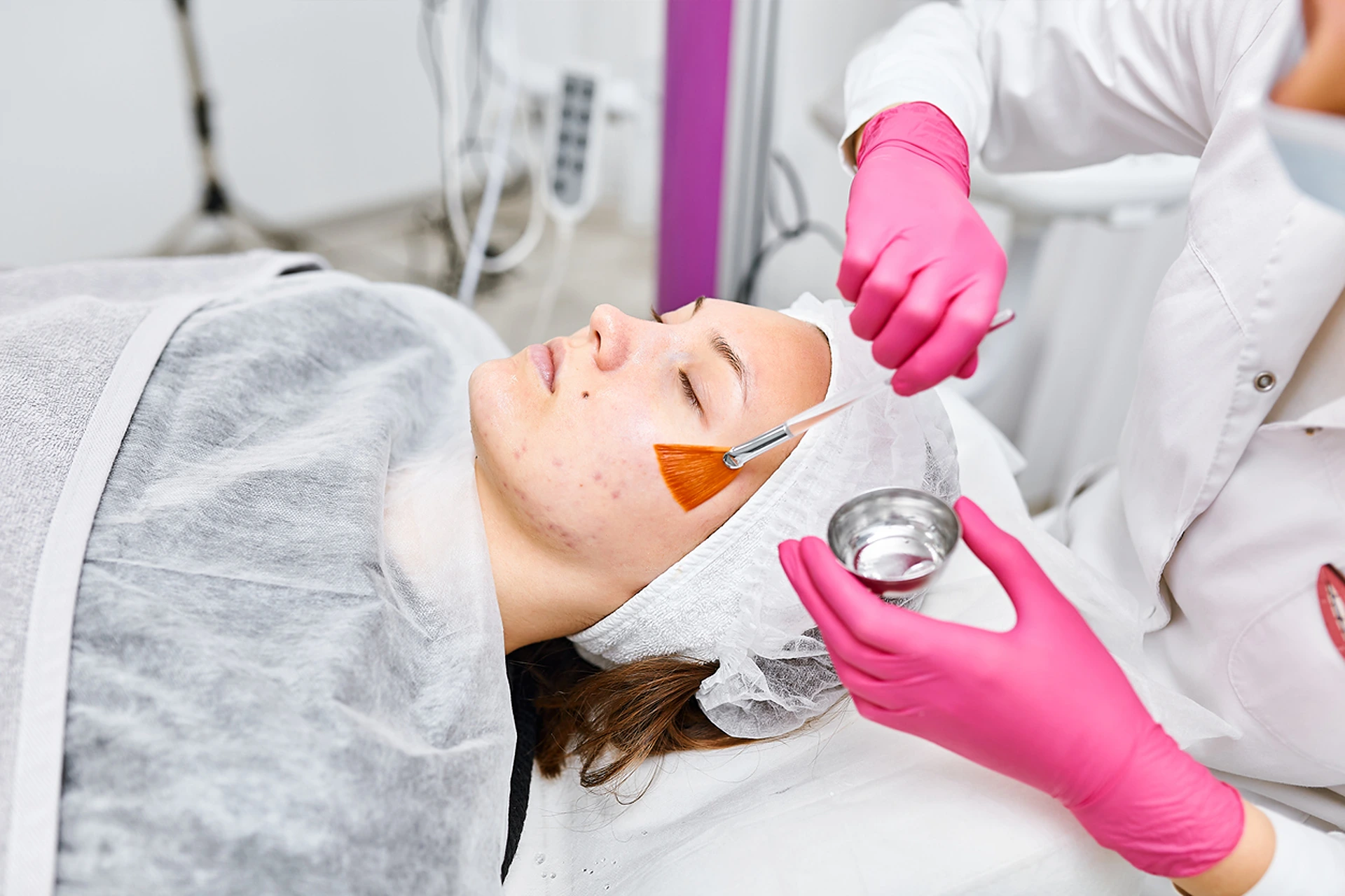 Fast-Track To Flawless Skin: The Power of Chemical Peels for Acne