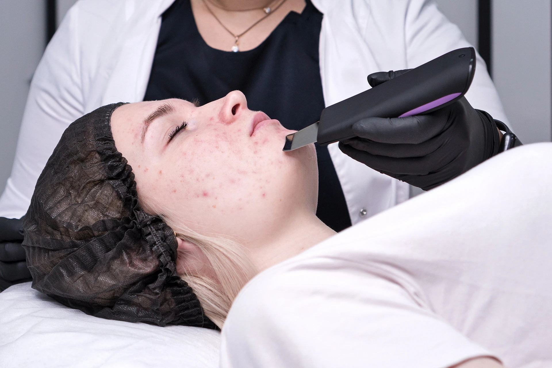 Does Dermaplaning Help with Acne?