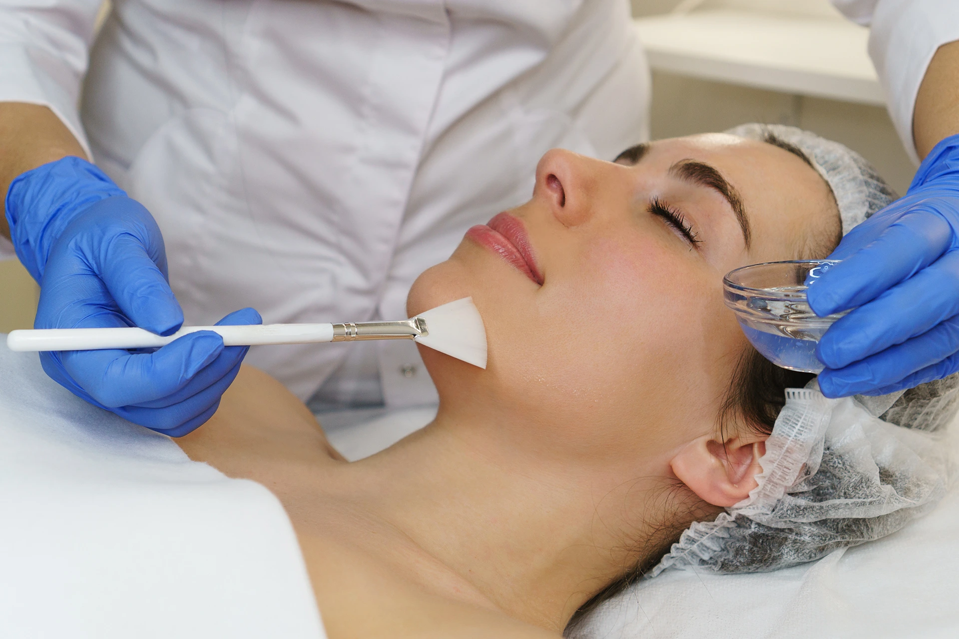 Chemical Peel for Melasma