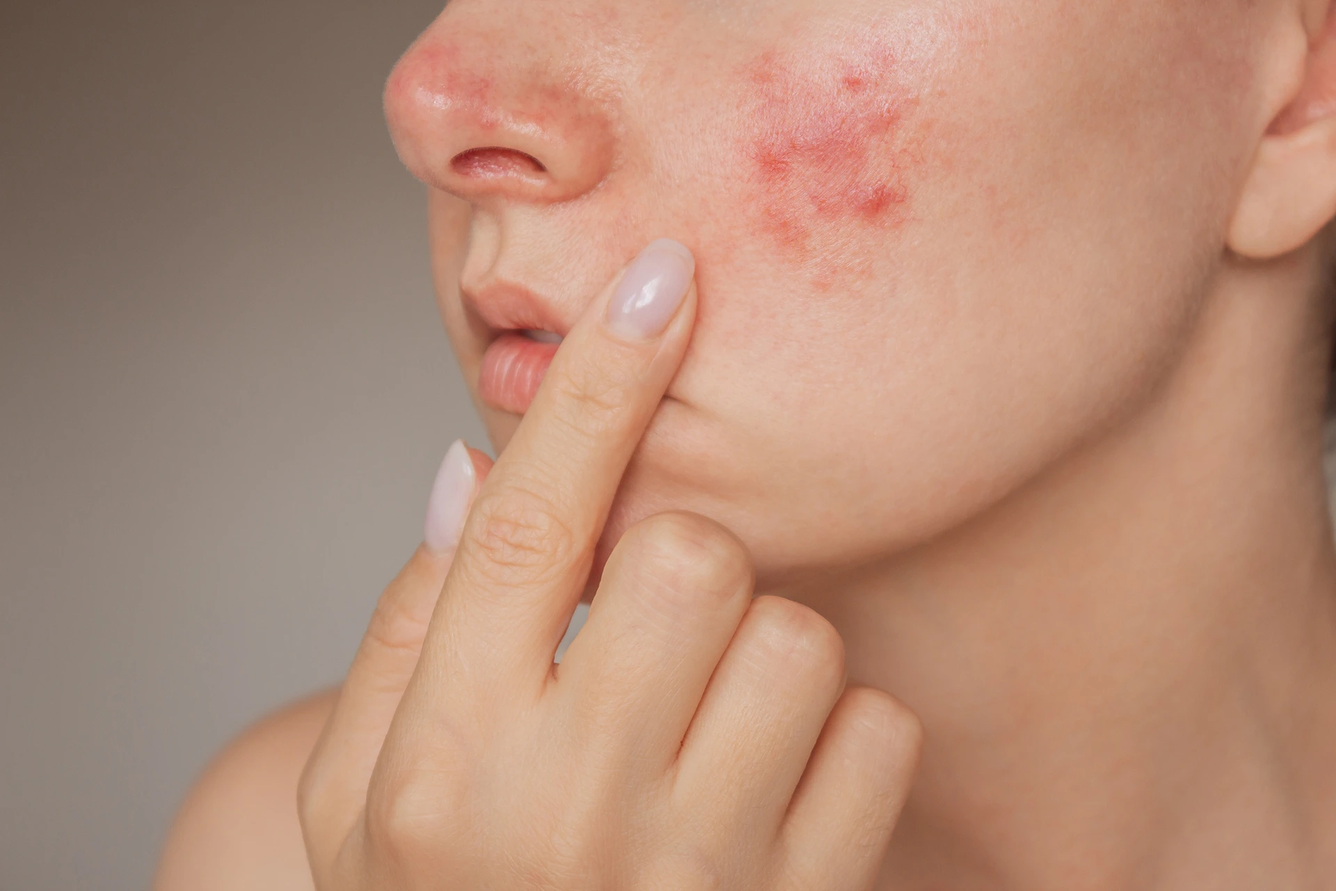 Does Dermaplaning Cause Acne?