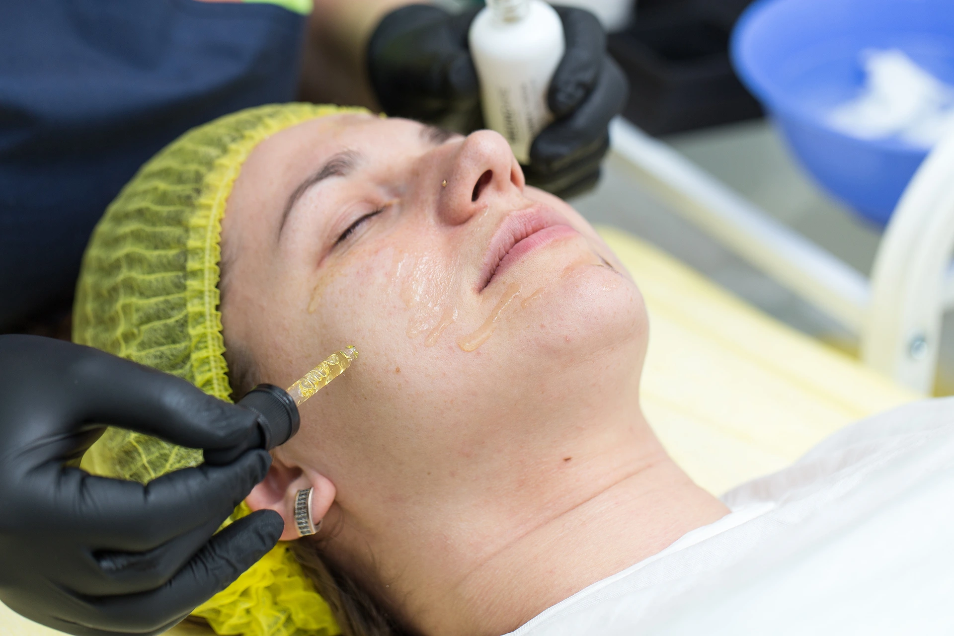 DIY Chemical Peels Made Easy: A Guide