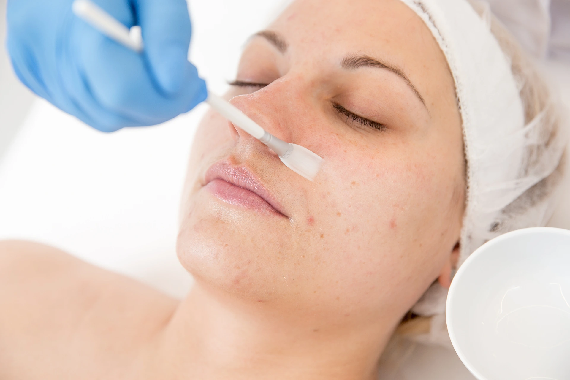Transform Your Skin with a Phenol Chemical Peel